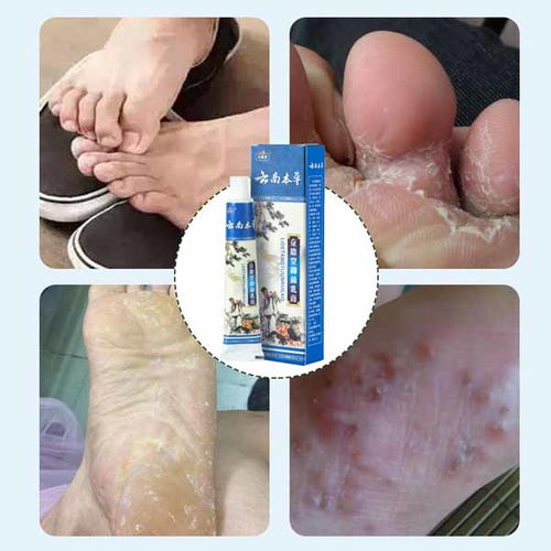 康凈衛(wèi)生用品 專業(yè)止癢噴劑廠家在線咨詢，您的個人衛(wèi)生守護(hù)者